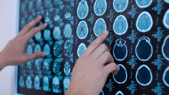 Analysis of brain x-ray in clinic